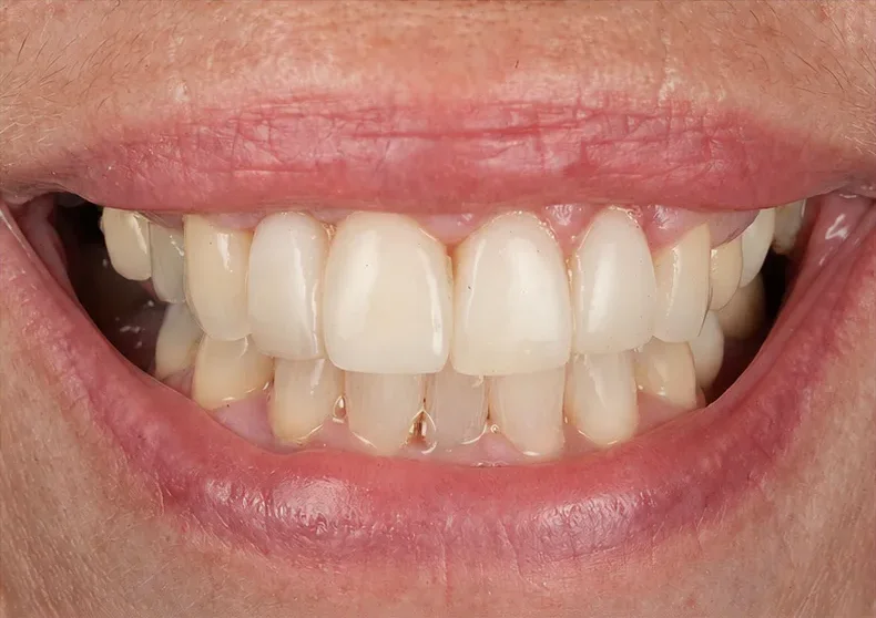 After treatment: the same smile with even, lighter upper teeth