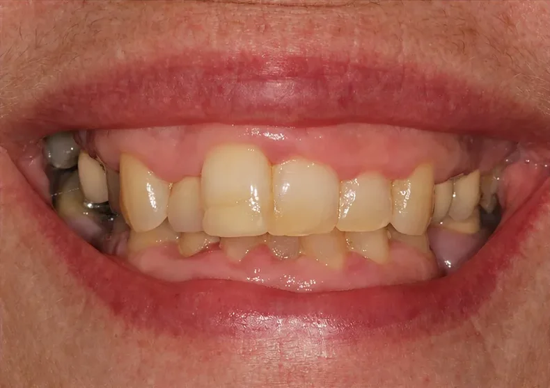Before treatment: worn, discoloured and uneven upper teeth of a Dental Studio patient