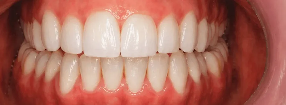 After Invisalign, composite bonding and whitening: straighter, brighter front teeth