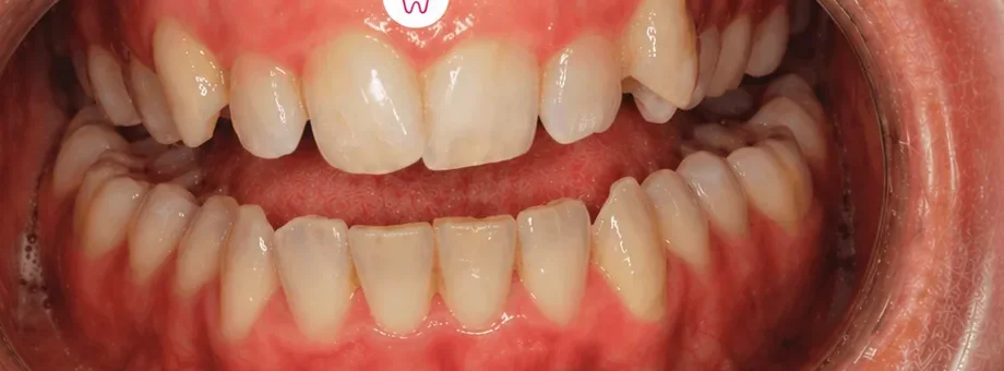 Before treatment: crowded, uneven front teeth photographed close up